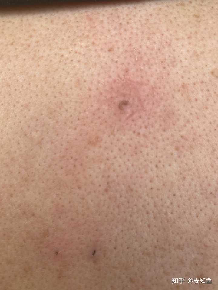 史上最大的黑头有多大?