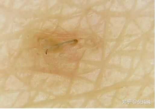 高清500倍实拍  鸡皮肤毛孔堵塞