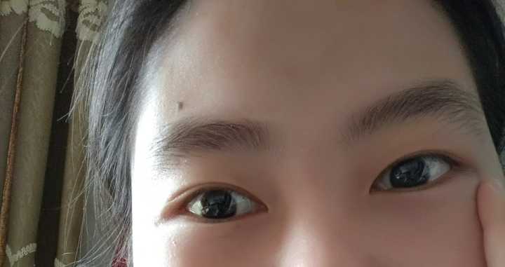 一觉睡醒之后单眼皮变双眼皮是一种怎样的体验?