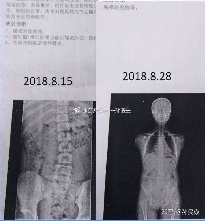 相隔13天的x光照片,提示什么是疼痛回避性脊柱侧弯.