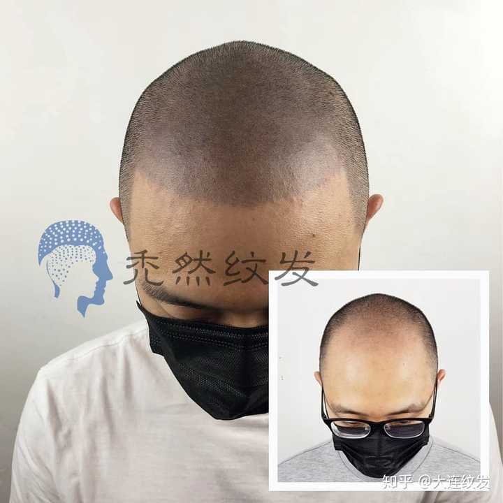 秃顶的男孩应该怎么办?