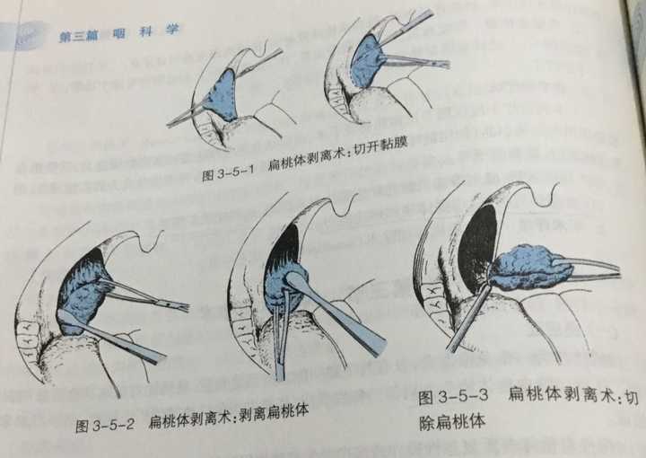 扁桃体结石是如何形成的?