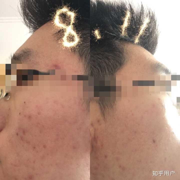 11号刚做完针清,看起来一个痘没有.