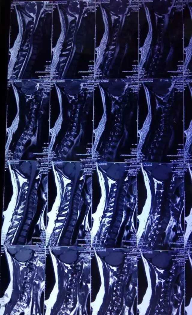 颈椎反弓应该如何治疗?