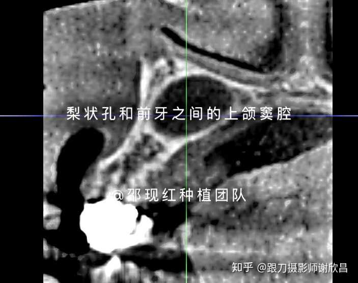 窦的下缘和后牙牙槽突有紧密的关系,是上颌种植需要特别注意的解剖