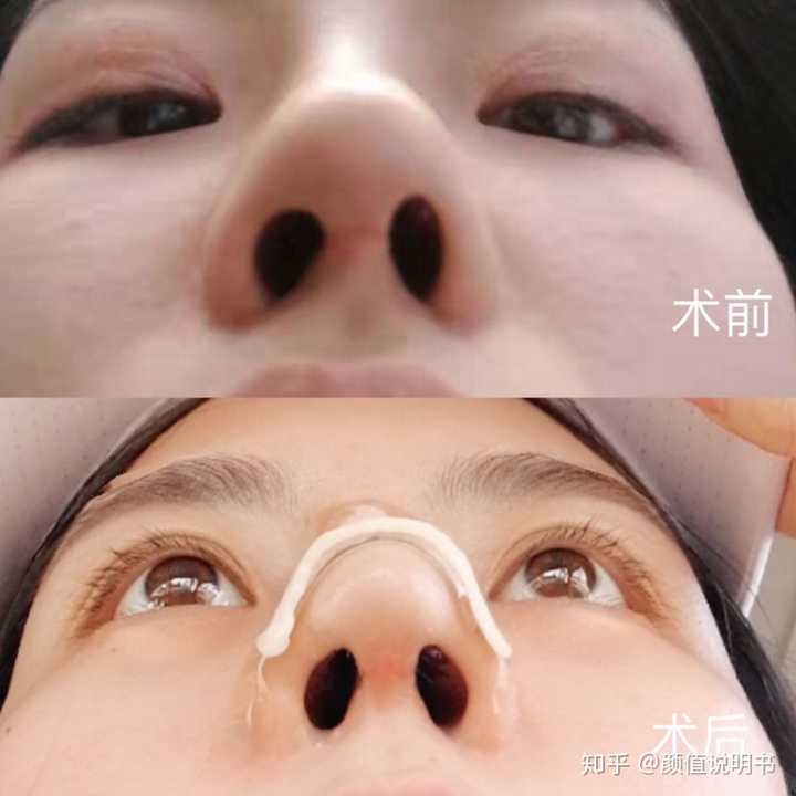 3号  术前两边鼻孔都不对称了,我之前有专门写过她修复的过程,有兴趣