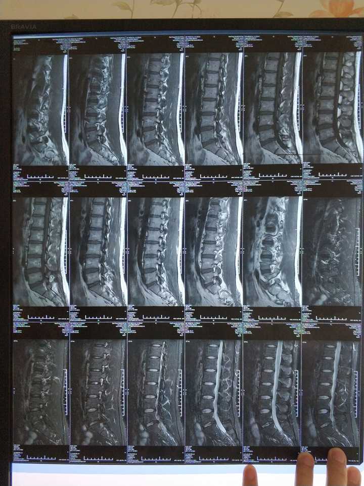 知乎上有髓核自吸收的腰椎间盘突出患者吗