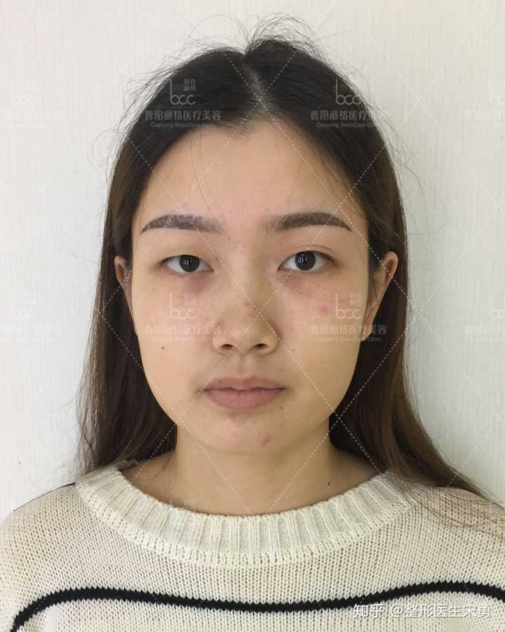 你见过的双眼皮手术最成功,效果最好的案例有哪些?