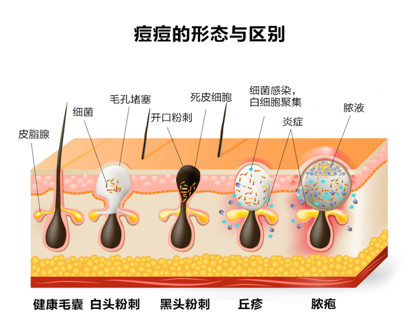 如果长了痘痘你会选择等身体自愈还是用护肤品进行治疗?