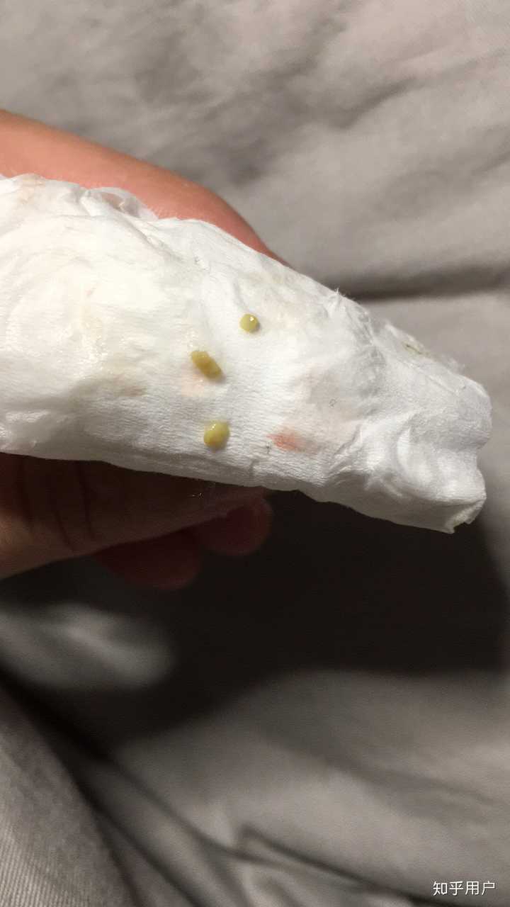 顺便告诉大家一个检测扁桃体结石的方法,如果你几个小时没吃东西不