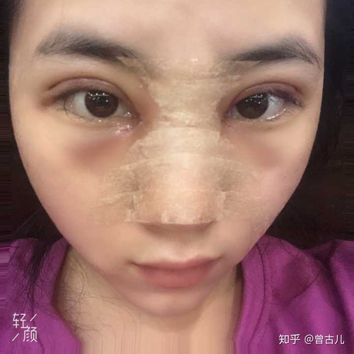 割双眼皮有什么危险吗?