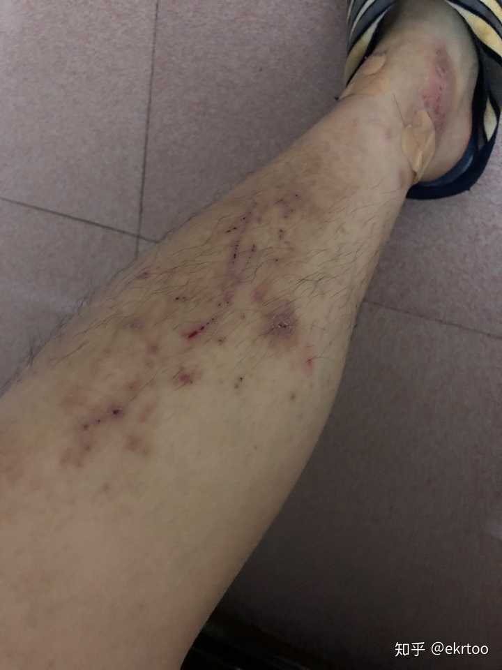 小腿特别痒,持续了两个月了,一直不好,越挠越痒挠破皮结了一腿的疤?