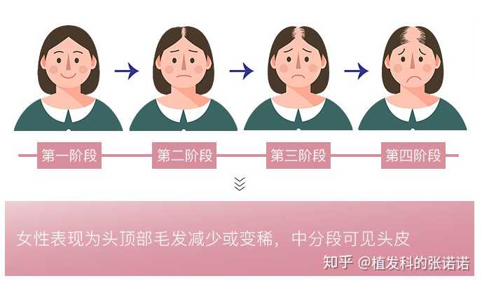 脂溢性脱发 喝