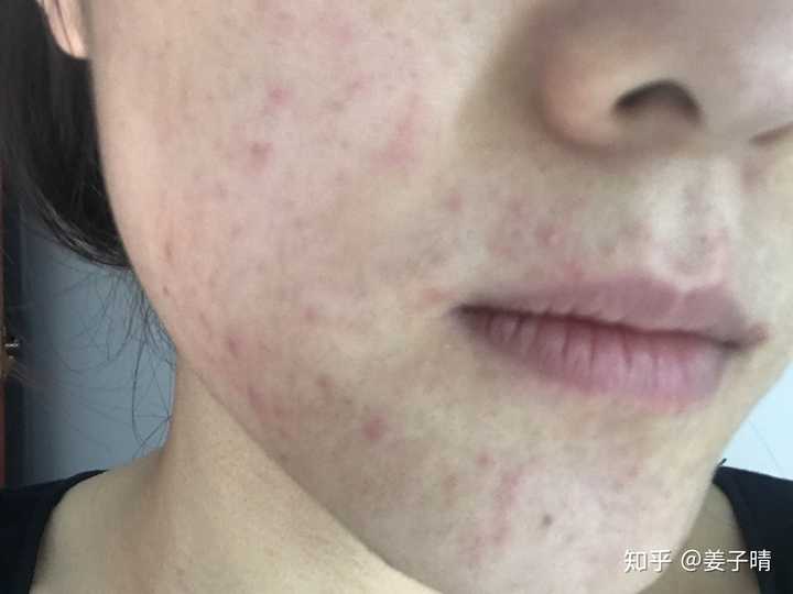 如何对待激素脸?
