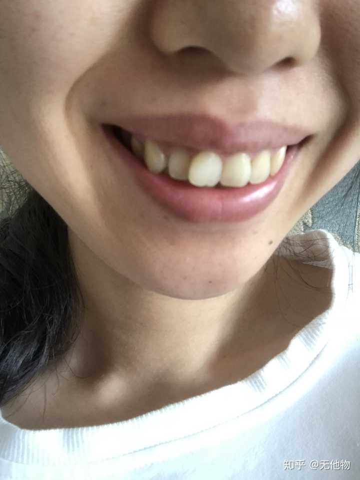 龅牙上颌双颌前突是怎样的体验