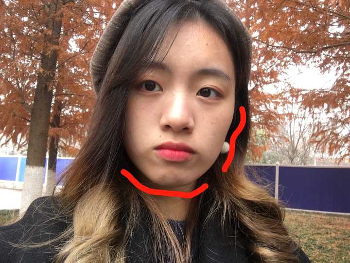 带牙套会给脸型带来哪些影响?