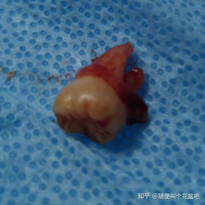 拔完智齿后那一周你经历了什么?