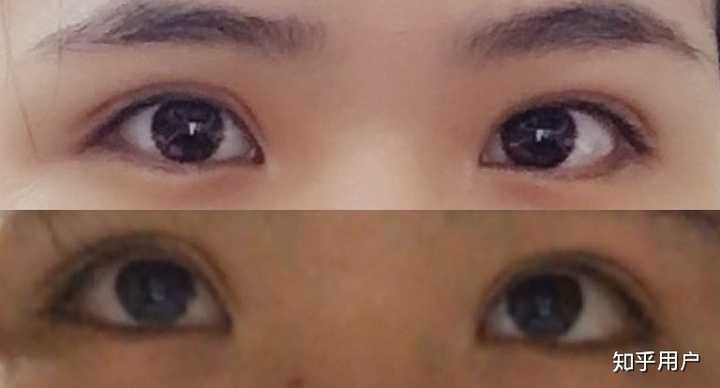 我在19年五月七号去了去中国医学科学院整形外科医院找王永前做了双