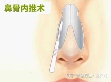 鼻骨内推会拉进眼距吗?