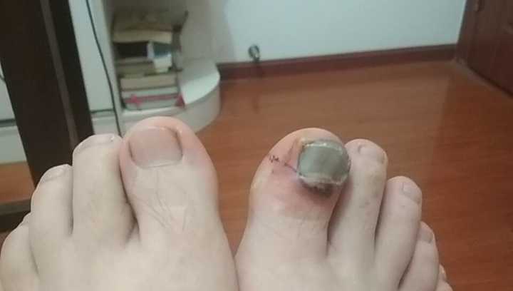 脚大拇指指甲被拔后怎么让它好起来