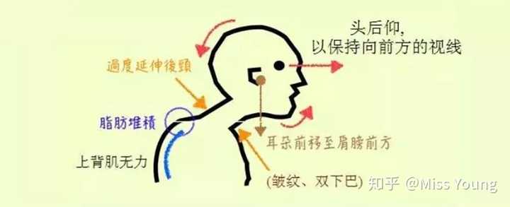 怎样改善脖子前伸?