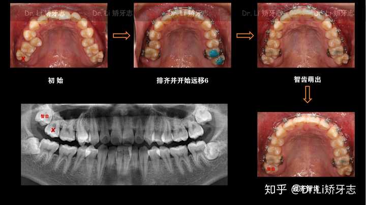 有谁带牙套用智齿代替后牙六七号成功的案例吗?