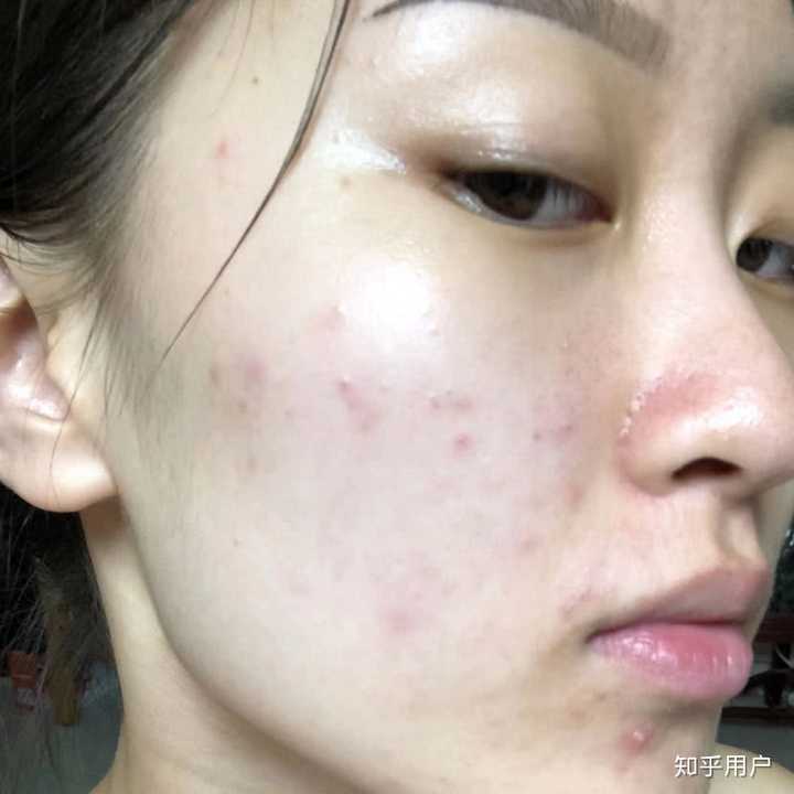 怎样去痘痘?消痘印?