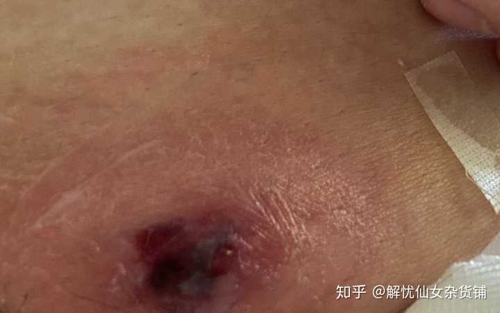 长火疖子怎么治很恐怖吗