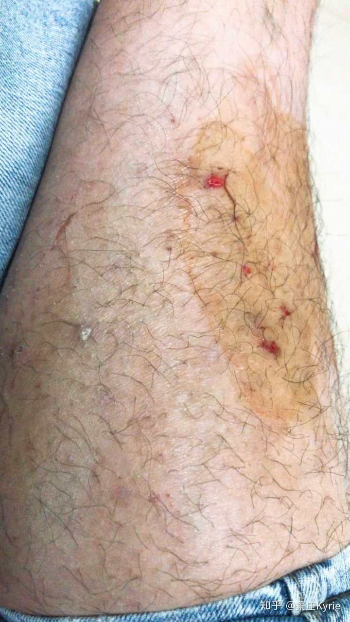 小腿痒痒越挠越痒 知乎