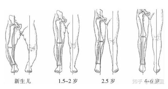 新生儿的腿部有点弯曲是正常现象,婴儿膝内翻明显,胫骨股骨向内成角