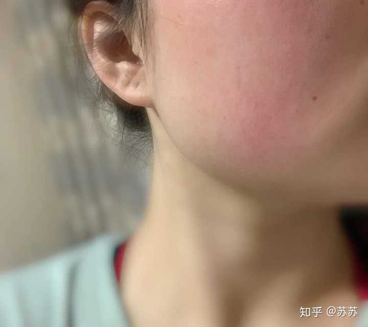 一般温度变化,过冷或过热皮肤都容易泛红,发热,那就是敏感肌肌肤了!