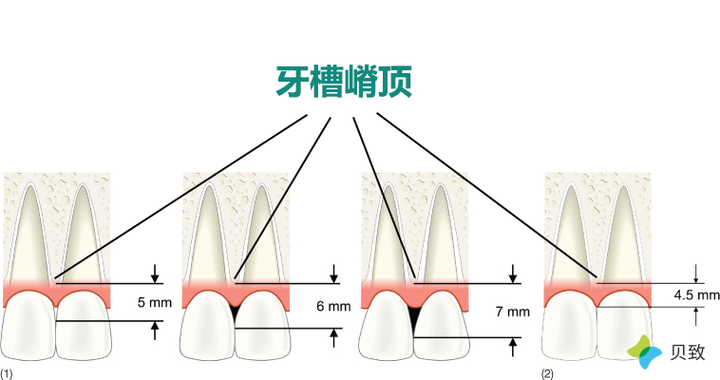 牙龈萎缩应该怎么办?