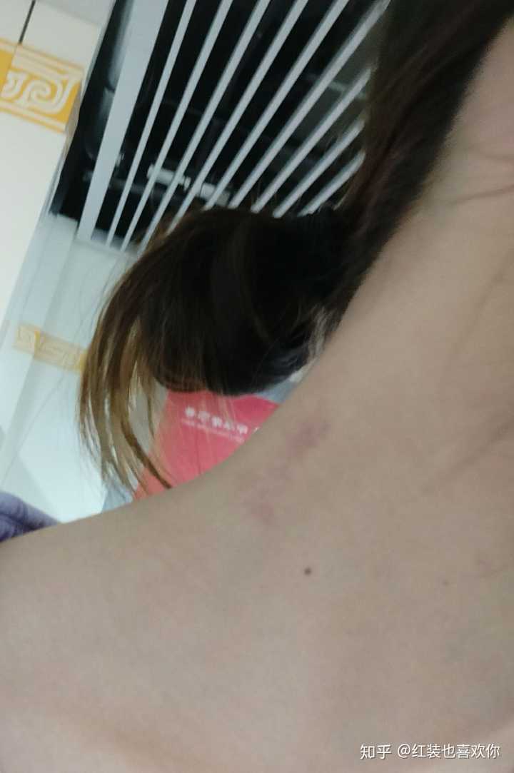 94脖子上有块小胎记 这地方是正常的对吧 可特么问题是红色的啊啊啊!