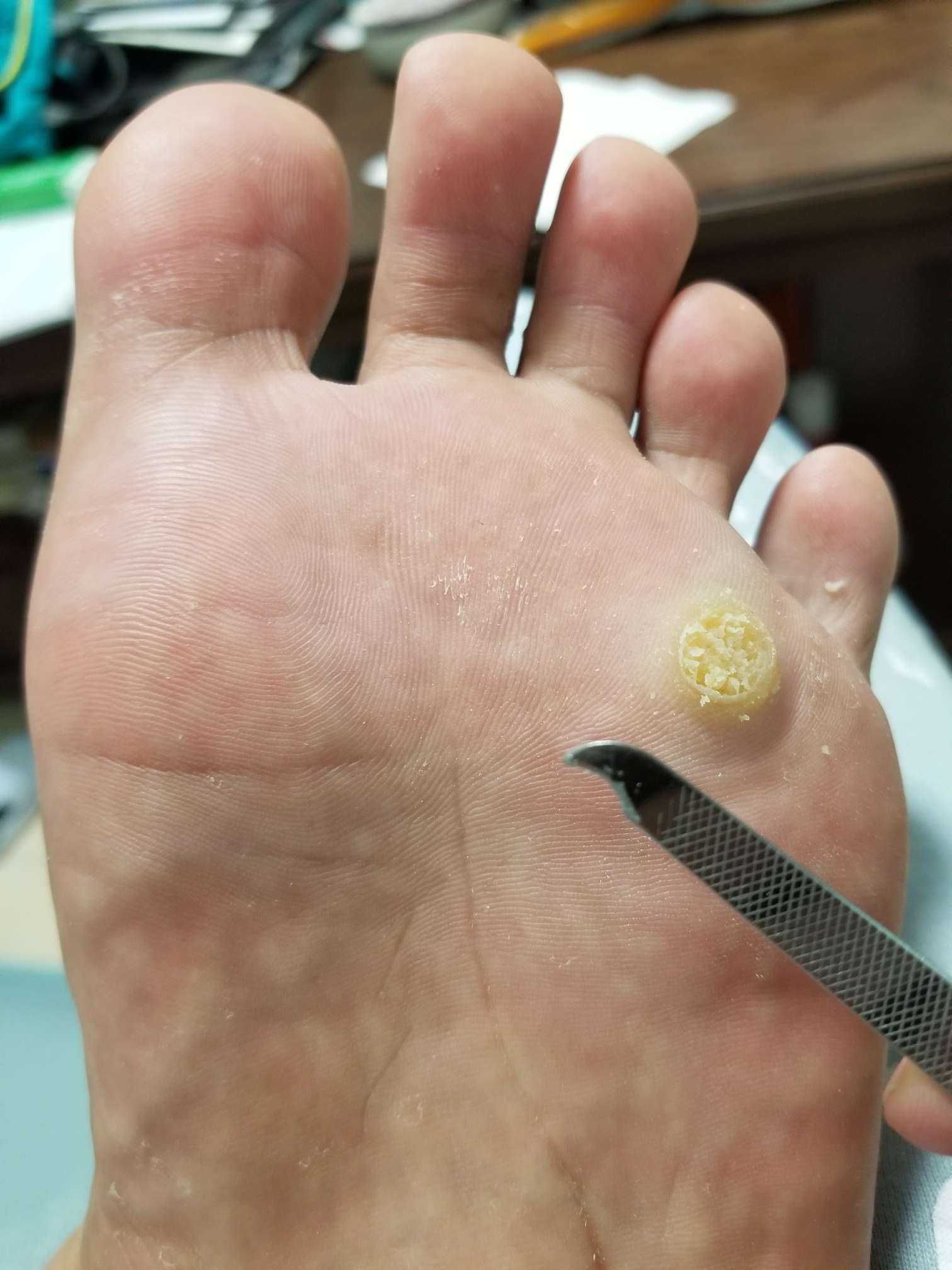 治愈鸡眼的攻略