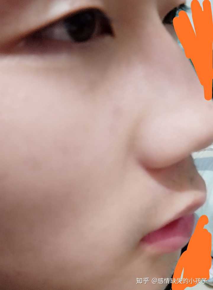 上嘴唇上翘,上翻怎么办?侧面看起来简直丑哭我!