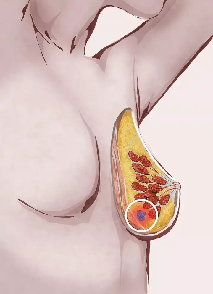 现在乳腺癌的治疗及存活率是怎样的?