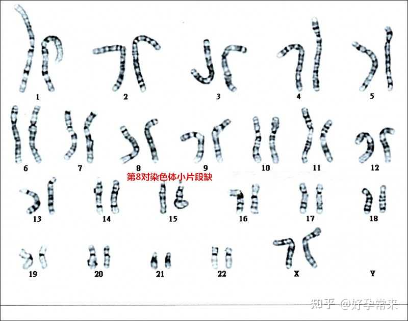 怀孕5个月羊穿结果第8号染色体缺失17m孩子能不能要急求帮助感谢