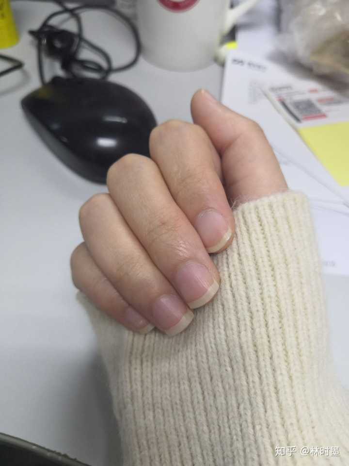 甲床过短应该如何变长?