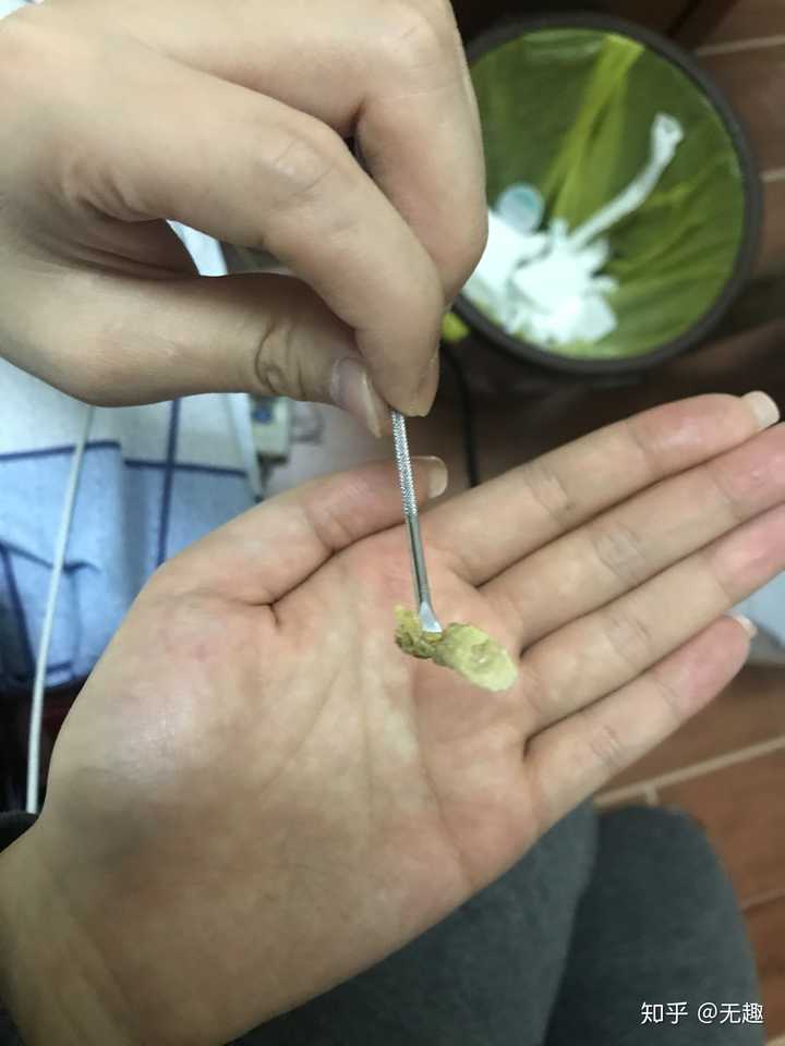 耳屎能大到什么程度?