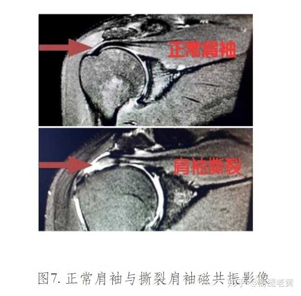 而盂唇是肩胛骨上的肩胛盂周围的一圈纤维软骨