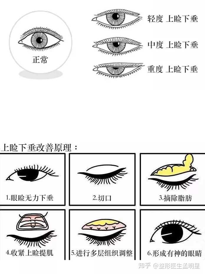 上眼睑下垂主要分为 先天性,后天性和假性三种