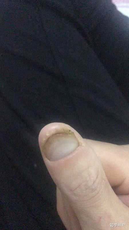 我灰指甲已经有十几年了,甲床几乎坏死,怎么治疗啊?