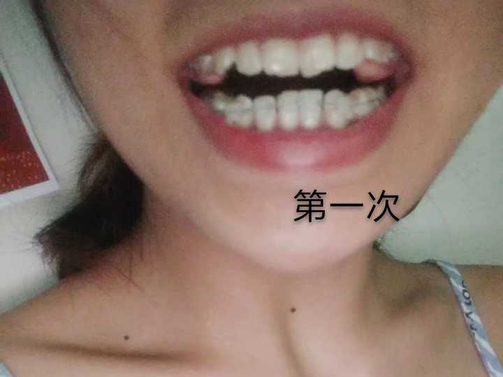 刚戴好牙套那天,上面弄了咬合垫(5.29)