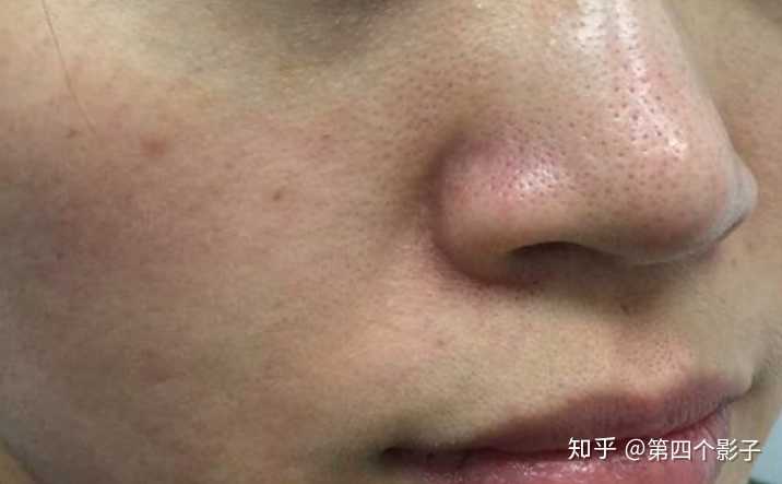 毛孔粗大主要和遗传,皮肤干燥,缺水,弹力纤维,胶原纤维断裂,毛囊角化