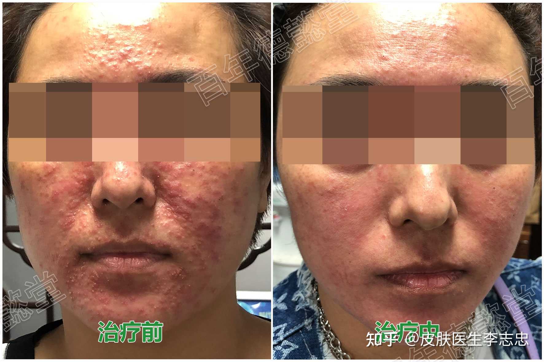 皮肤医生李志忠 的想法: 玫瑰痤疮,是皮肤顽疾,很难治