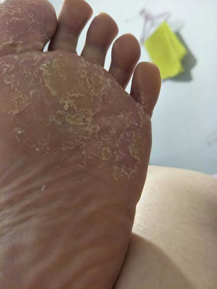 这里说的脚气指的是足癣,和脚气病相差十万八千里,这个一定要明确.