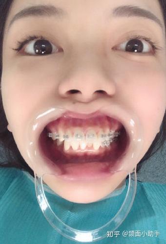 牙齿矫正后有哪些后遗症?