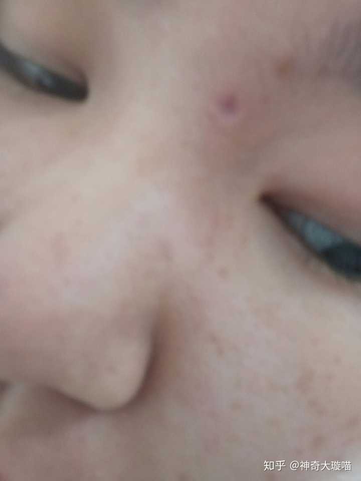 我是在四月中旬起的水痘,现在水痘都起痂了,痂是自己脱落的但是有坑
