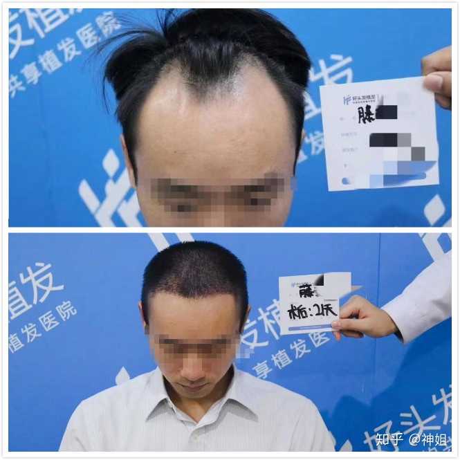 20岁发际线后移呈m型怎么办?