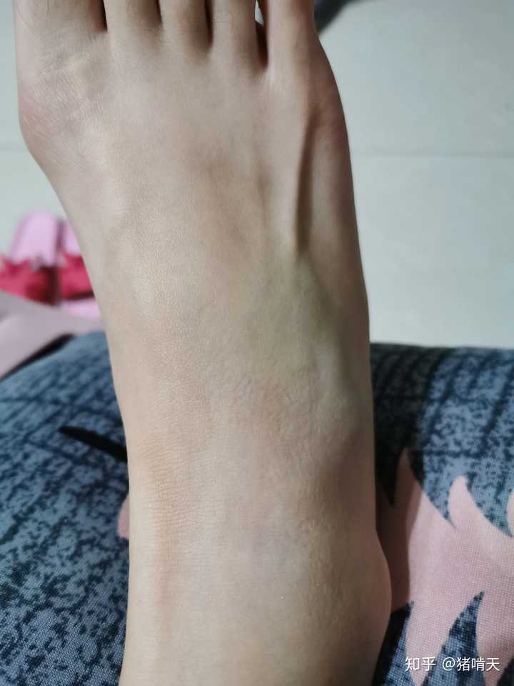 崴一脚骨折的可能性大么